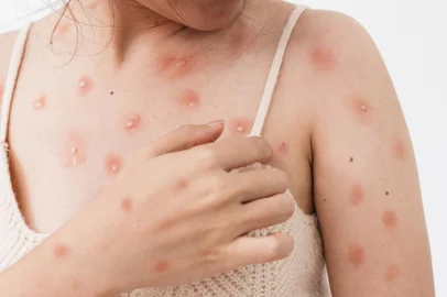 Concept of monkeypox epidemic, white woman Skin erythema, pustules, and boils, itching after being infected with the monkeypox virus.*A PEDIDO DE GABRIELA PERUFO* Vírus da monkeypox, a varíola do macaco - Foto: Somboon/stock.adobe.comIndexador: Somboon KeaoboonsongFonte: 508884278<!-- NICAID(15233880) -->