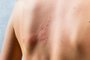 chickenpox rash. Shingles, varicella-zoster virus. skin rash and blisters on body. Skin infected Herpes zoster virus. Herpes Virus on body. urticaria rash. atopic dermatitischickenpox rash. Shingles, varicella-zoster virus. skin rash and blisters on body. Skin infected Herpes zoster virus. Herpes Virus on body. urticaria rash. atopic dermatitis.Fonte: 481167333<!-- NICAID(15128484) -->