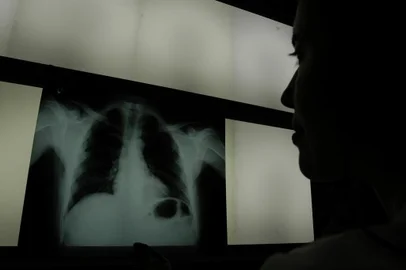 *** Pneumonia-RicardoW ***Doenças Respiratórias,PneumoniaMédica analiza um raio X.De um pulmão no hospital Pompéia
