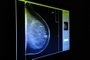  Blumenau-sc-Brasil, Rede feminina de combate ao câncer de mama recebe apoio financeiro da prefeitura para exames de mamografia