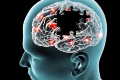 Medicamentos utilizados para tratar o diabetes também podem ser usados para tratar a doença de Alzheimer, e vice-versa, de acordo com um estudo recente da Universidade de Aberdeen, na Escócia.
Esse é também o primeiro estudo desse tipo que mostra que a doença de Alzheimer pode levar ao diabetes. Até agora, acreditava-se que pessoas obesas desenvolvem diabetes tipo 2 e, então, estariam mais propensas a desenvolver demência. Quer dizer, que o diabetes começava como um defeito no pâncreas ou por causa de uma dieta muito rica em gordura e açúcar. Nesse estudo mostrou-se que as alterações no cérebro causadas pelo Alzheimer podem, igualmente, levar ao desenvolvimento de um diabetes muito severo.

l Mudando conceitos

No artigo, publicado no jornal Diabetologia ¿ o jornal da Associação Europeia para o Estudo do Diabetes ¿ os pesquisadores desenvolveram um modelo de Doença de Alzheimer e encontraram que um aumento no funcionamento de um gene envolvido na produção de proteínas tóxicas no cérebro, não somente levava ao sintomas típicos do Alzheimer, mas também ao desenvolvimento das complicações do diabetes.