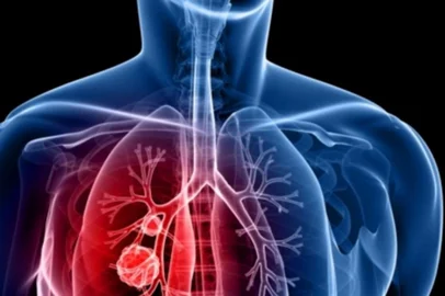 Imunoterapia contra o câncerSe você conhece alguém em tratamento do câncer de pulmão, compartilhe esta: o Centro de Novos Tratamentos Itajaí começa a recrutar pacientes para um novo tratamento chamado de Imunoterapia: ele estimula o sistema imunológico a combater as células cancerígenas e impedir que as células ruins cresçam - ou de alguma forma se escondam do sistema de defesa do organismo humano. De acordo com especialistas da área, diferente da quimioterapia e da radioterapia (onde células boas também são destruídas) a imunoterapia apresenta menos efeitos colaterais e resultados positivos.  