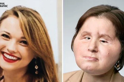  Katie Stubblefield antes e depois de ter passado pela cirurgia de transplante facial