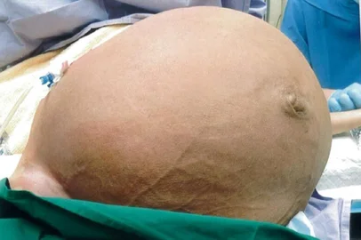  Tumor uterino gigante