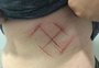 Polícia apura ataque a jovem que foi agredida e teve suástica marcada no corpo com canivete em Porto Alegre