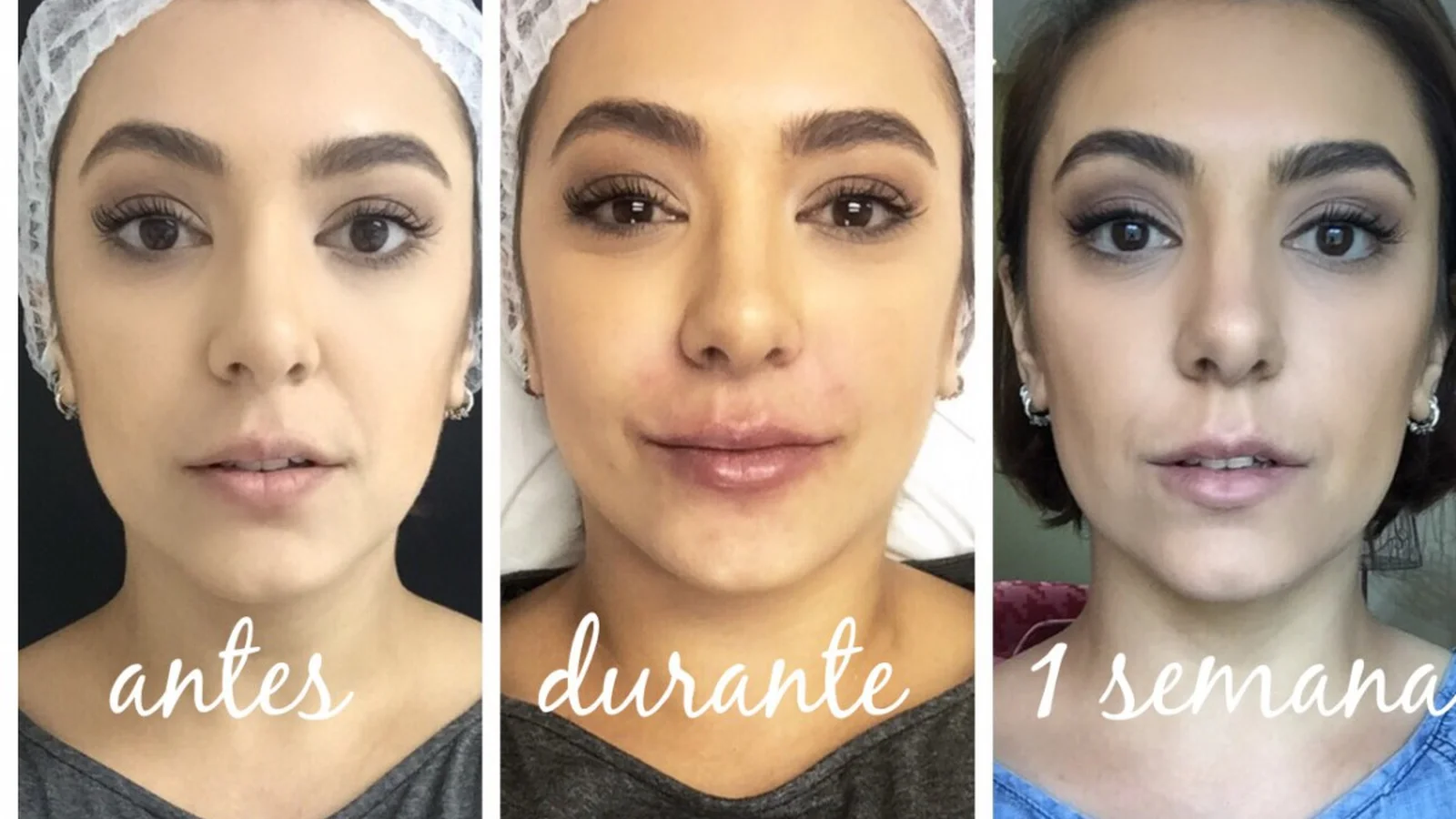 Botox Labial Superior Antes E Depois