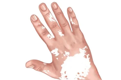 O vitiligo é uma desordem na pigmentação da pele que provoca manchas brancas em várias partes do corpo.