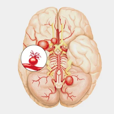 aneurisma +Saúde