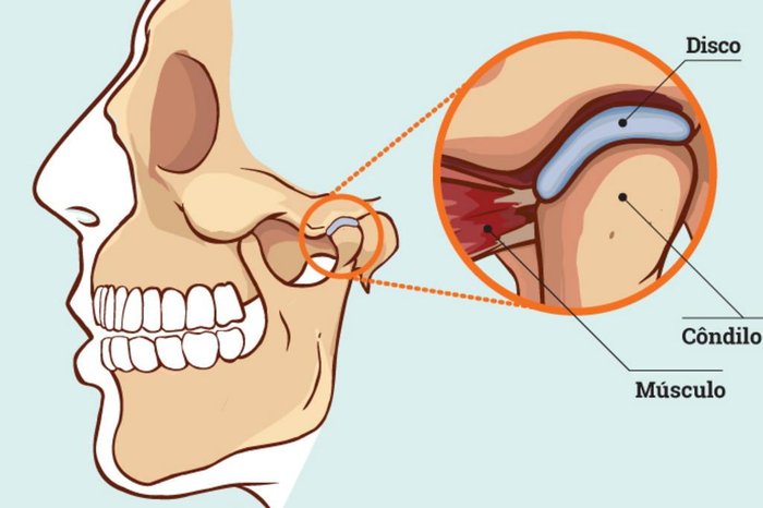 Mandíbula travada? . 📢Olha o que acontece quando o disco que protege a  articulação mandibular sai fora do lugar! . 👉O estralido é forte e a dor  também, a, By Exercitá Fisioterapia