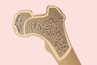 osteoporose, +saúde<!-- NICAID(14397591) -->