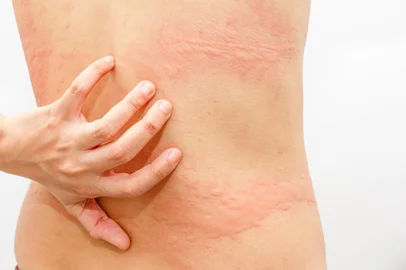  Women with symptoms of itchy urticaria.Fonte: 119502415Fotógrafo: Women with symptoms of itchy urt<!-- NICAID(14516283) -->