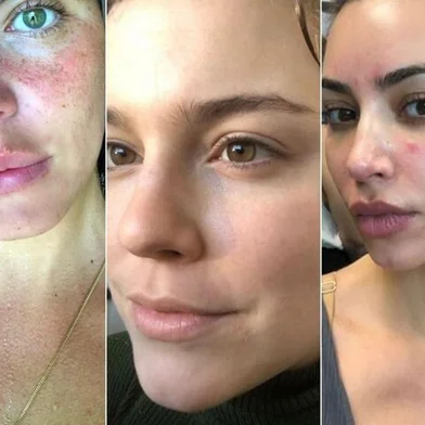 Famosas mostram problemas de pele. Kim Kardashian, Mariana Goldfarb  e Alice Wegmann<!-- NICAID(14793539) -->