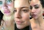Acne, psoríase, melasma: famosas abrem o jogo sobre seus problemas de pele