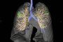 Check Lung alia inteligência artificial ao exame de tomografia computadorizada para detecção ultraprecoce do câncer de pulmão e de outras doenças. Em uso no Hospital São Lucas da PUCRS, em Porto Alegre.<!-- NICAID(14849758) -->