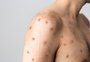 O avanço da monkeypox