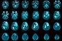 Ressonância magnética do cérebro - Foto: Richman Photo/stock.adobe.comFonte: 456113555Fotógrafo: Magnetic resonance imaging Findi<!-- NICAID(15338485) -->