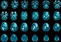 Pesquisadores identificam dois compostos capazes de inibir o crescimento de células de tumores cerebrais