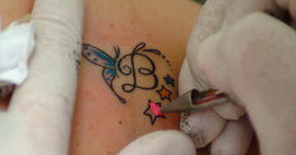 Aplicativos para remover tatuagem Aplicacao A Laser E Metodo Mais Eficiente Na Remocao De Tatuagens Gzh